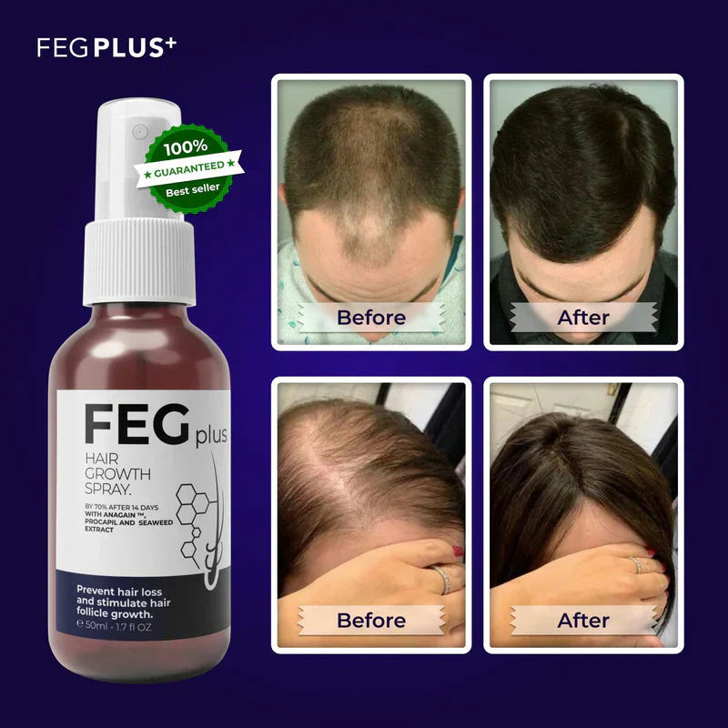 πΏ FEG Plus Hair Growth Spray π§ | π Anti-Hair Loss Treatment for Men & Women π§βπ¦±π©βπ¦° | β‘ Boosts Regrowth & Thickens Hair πͺ | Minoxidil + Herbal Extracts π± | 50ml Bottle